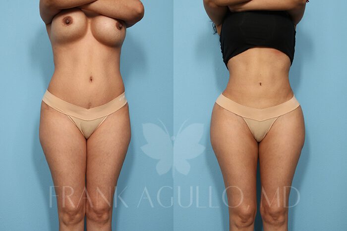 Butt Implants Before and After 4