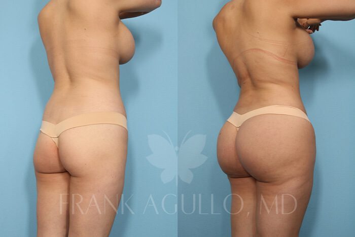 Butt Implants Before and After 2