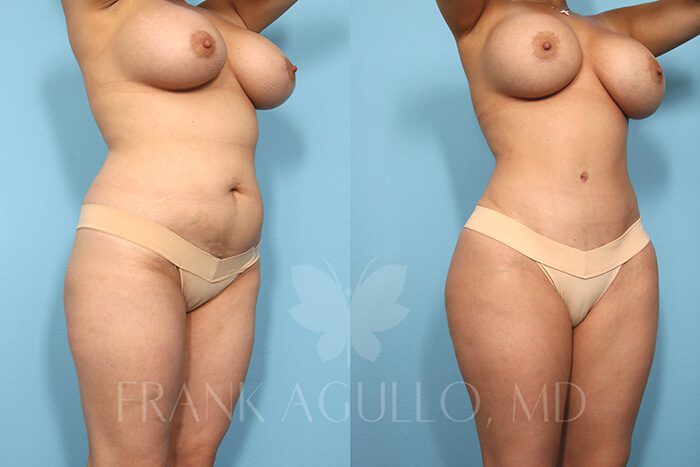 Butt Implants Before and After 3