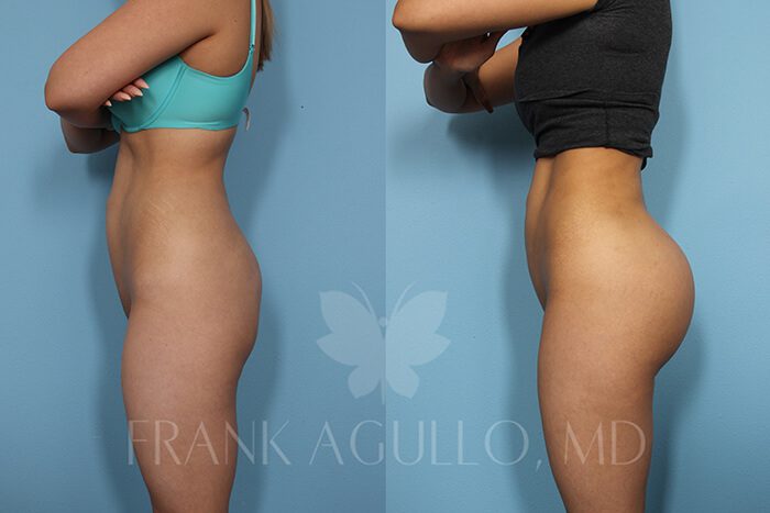 Butt Implants Before and After 2