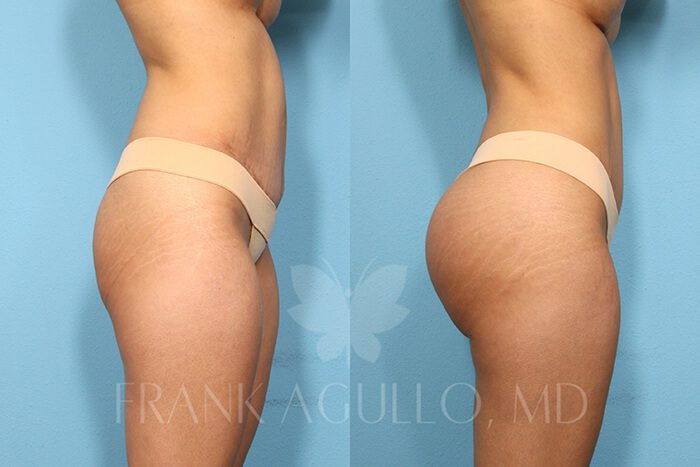 Butt Implants Before and After 2