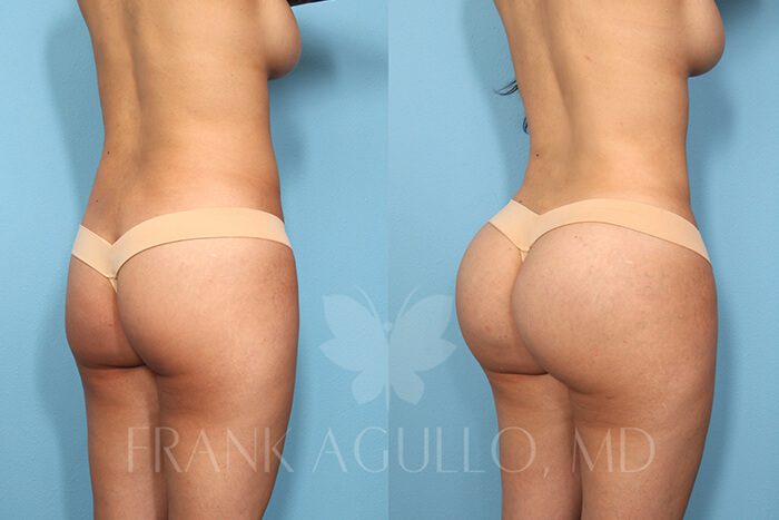 Butt Implants Before and After 3