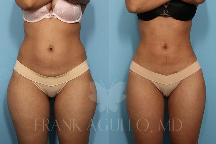 Liposuction Before and After 19