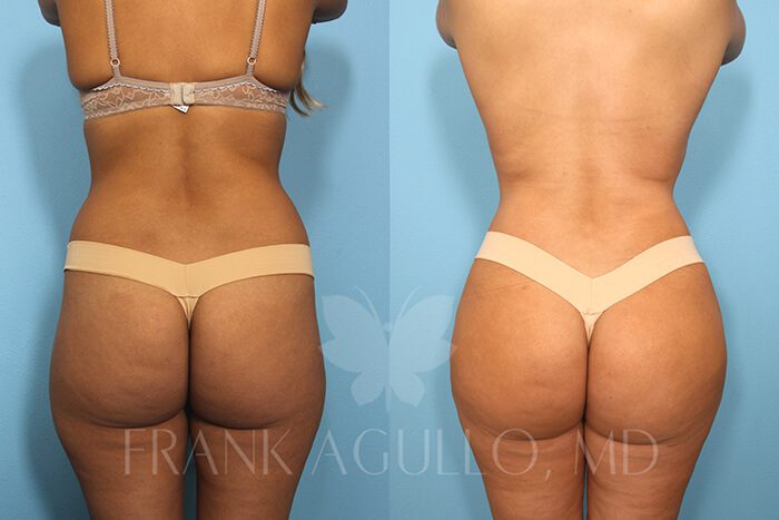 Liposuction Before and After 18