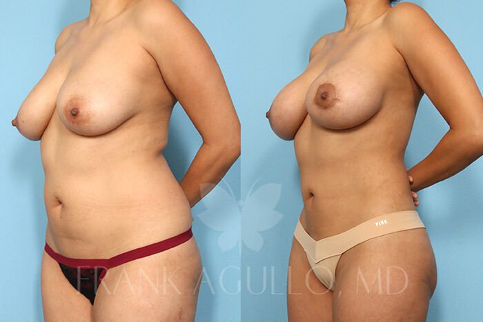 Liposuction Before and After 17