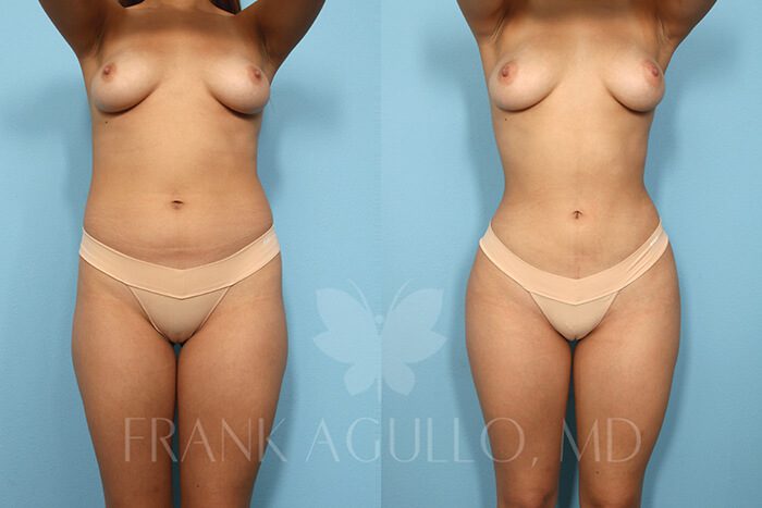 Liposuction Before and After 16