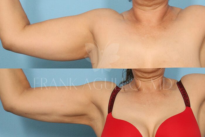 Liposuction Before and After 14