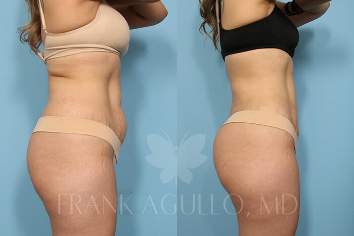 Liposuction Before and After 13