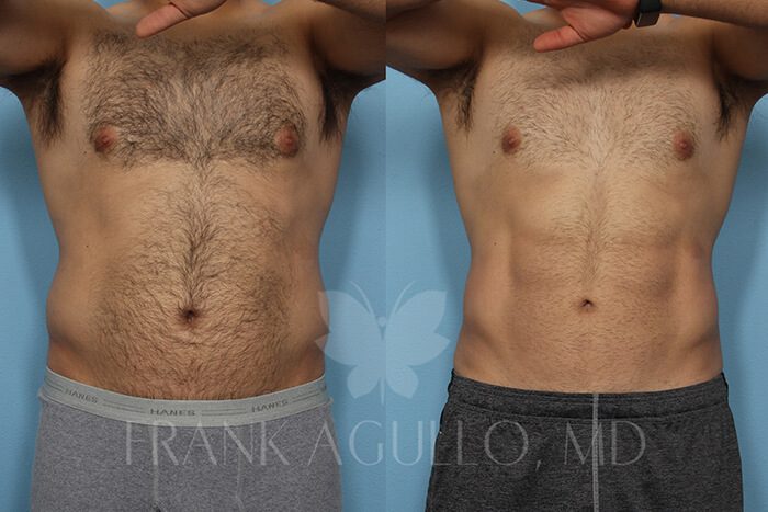 Liposuction Before and After 10