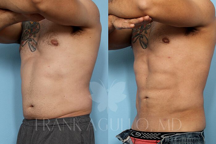 Liposuction Before and After 9