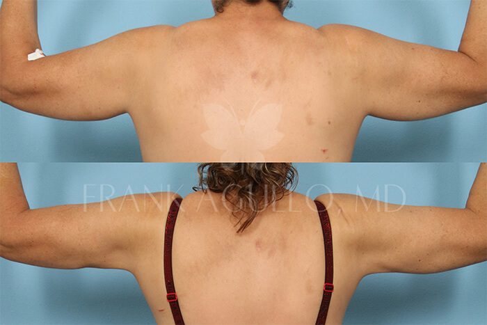 Liposuction Before and After 8