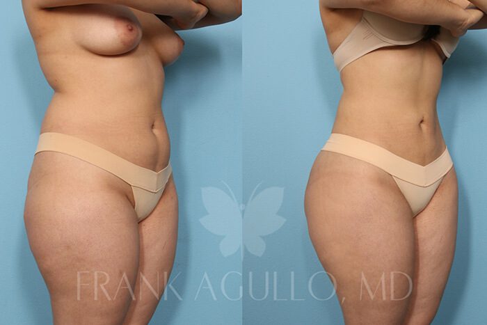 Liposuction Before and After 7