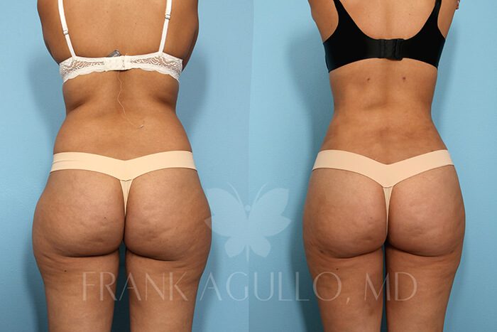 Liposuction Before and After 4