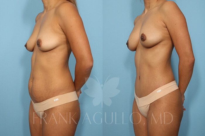 Mommy Makeover Before and After 2