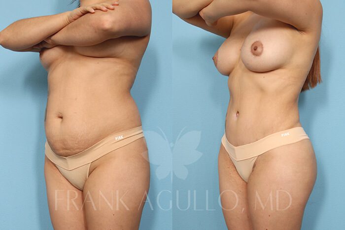 Mommy Makeover Before and After 2