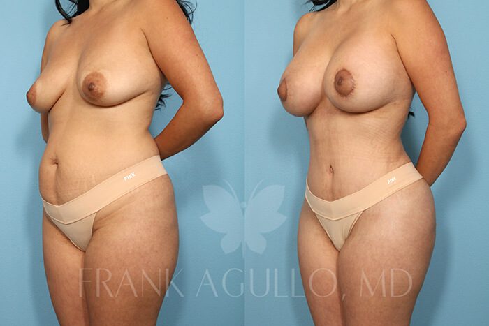 Mommy Makeover Before and After 2