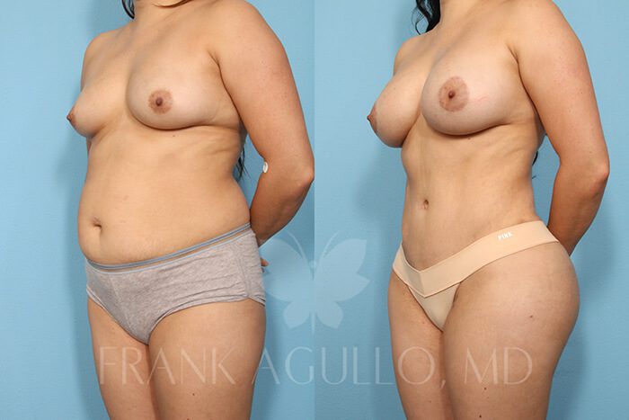 Mommy Makeover Before and After 2