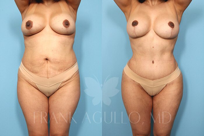 Mommy Makeover Before and After 2