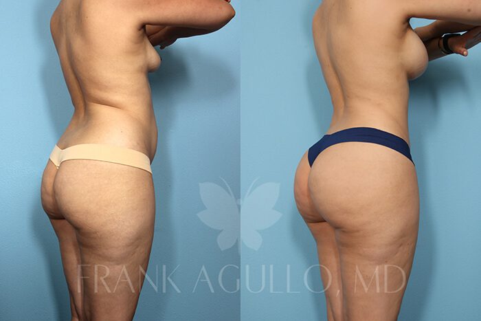 Mommy Makeover Before and After 3