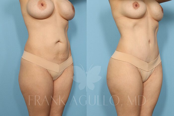 Mommy Makeover Before and After 2