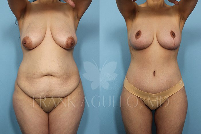 Mommy Makeover Before and After 2