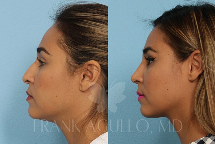 Rhinoplasty Before and After 2