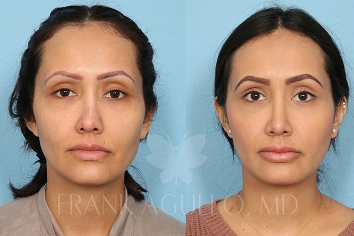 Rhinoplasty Before and After 1