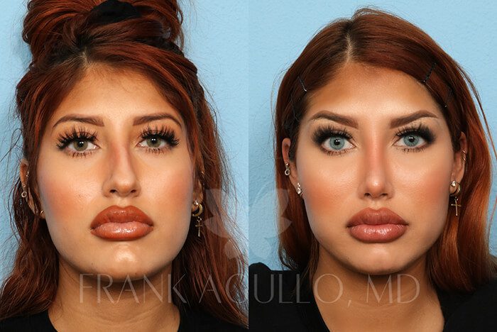 Rhinoplasty Before and After 20