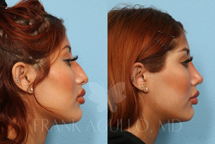 Rhinoplasty Before and After 2