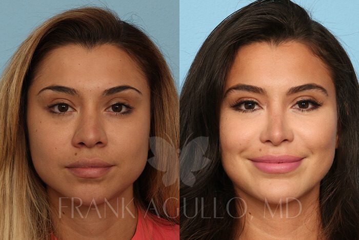 Rhinoplasty Before and After 19