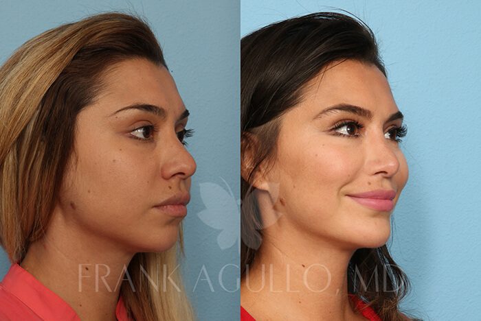 Rhinoplasty Before and After 2