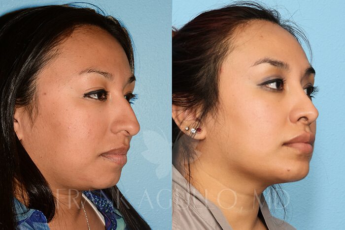 Rhinoplasty Before and After 18