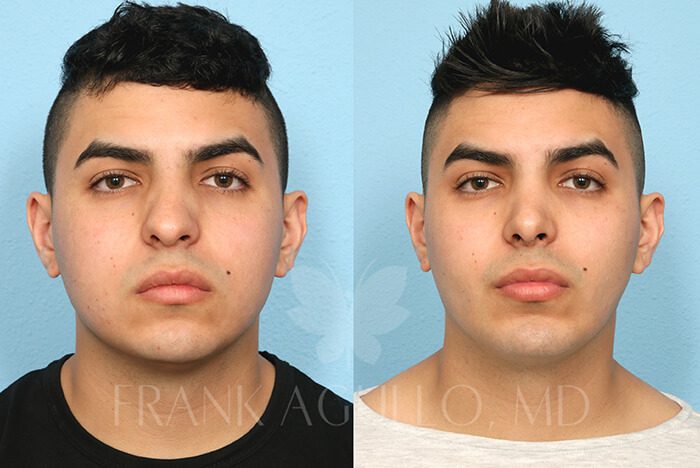 Rhinoplasty Before and After 17