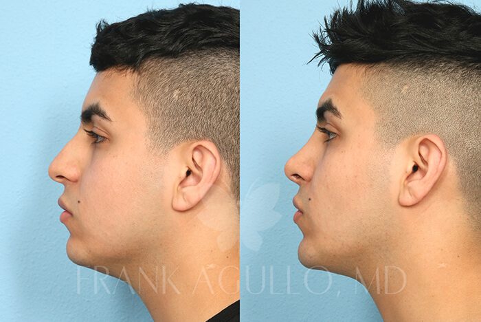 Rhinoplasty Before and After 2