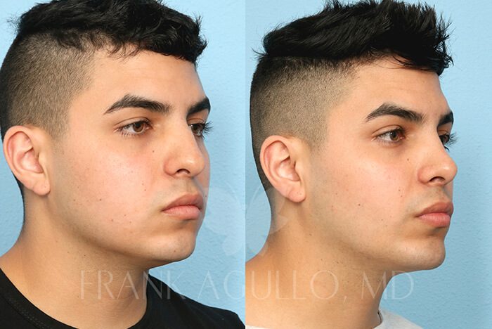 Rhinoplasty Before and After 3