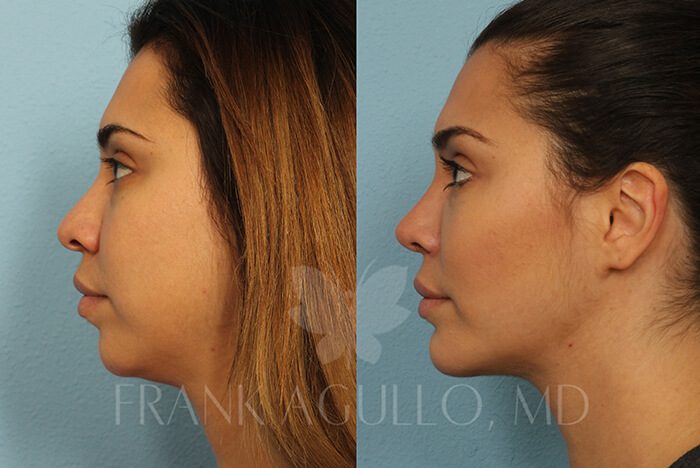 Rhinoplasty Before and After 16