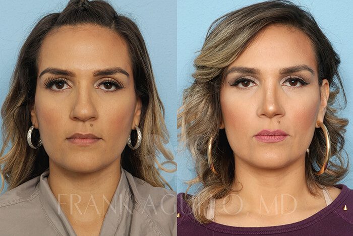 Rhinoplasty Before and After 15