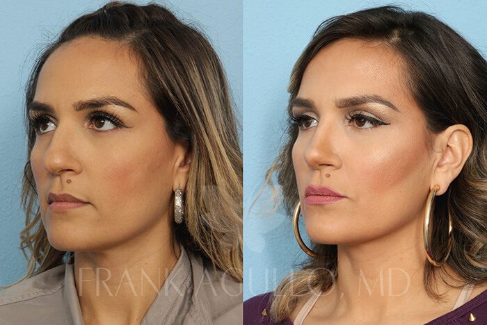 Rhinoplasty Before and After 2