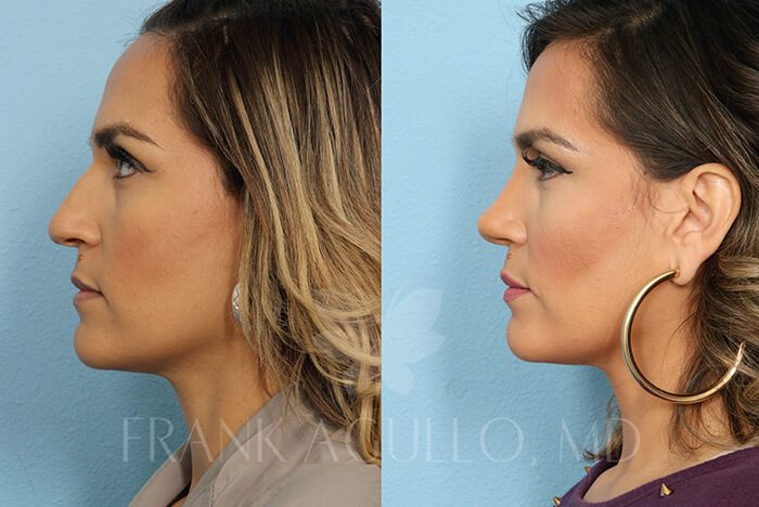 Rhinoplasty Before and After 3