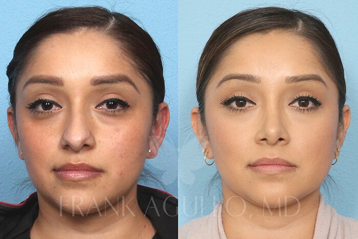 Face Before and After 5