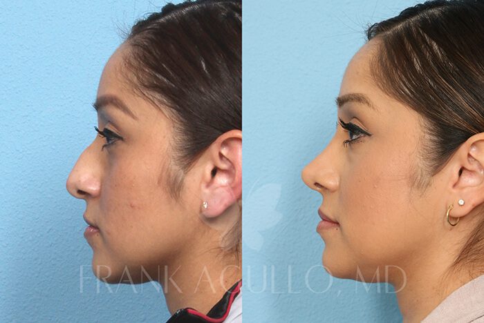 Rhinoplasty Before and After 2