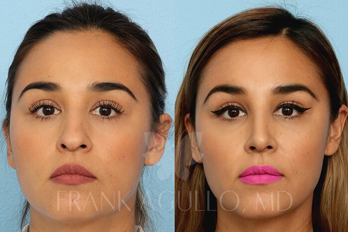 Rhinoplasty Before and After 13