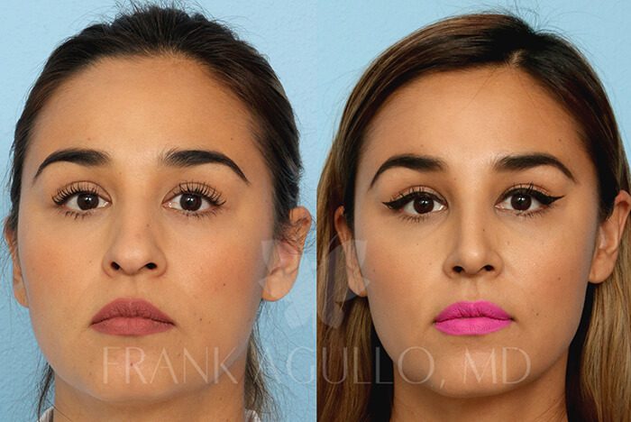 Rhinoplasty Before and After 13