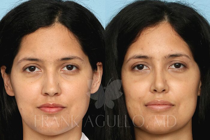 Face Before and After 3