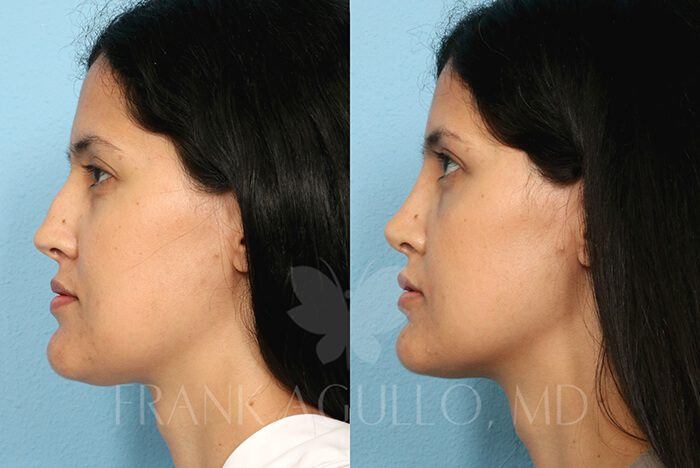 Rhinoplasty Before and After 2