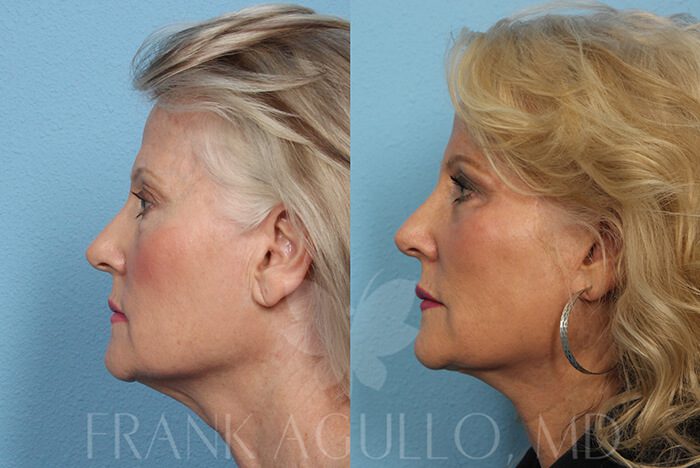 Rhinoplasty Before and After 11