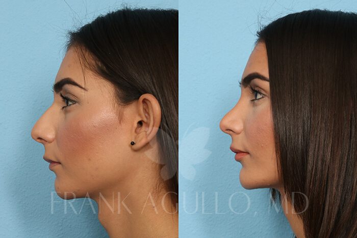 Rhinoplasty Before and After 10