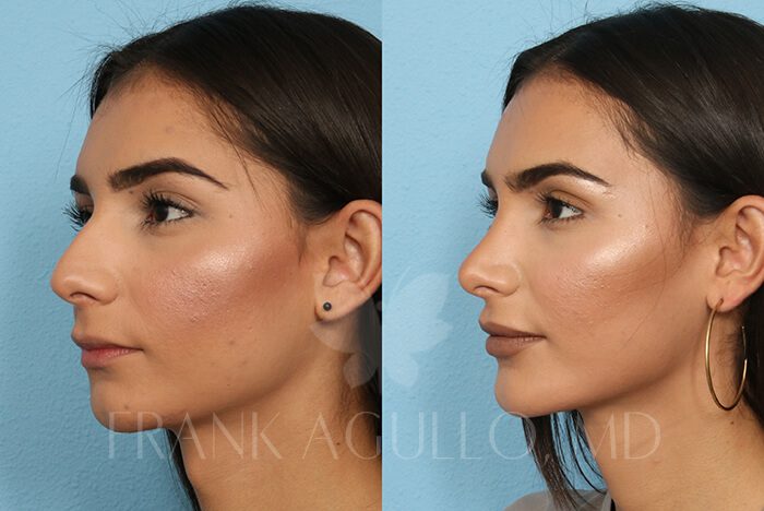 Rhinoplasty Before and After 2