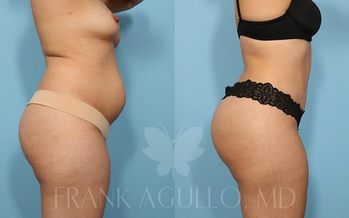 Tummy Tuck Before and After 2