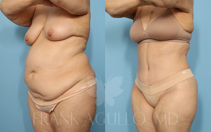 Tummy Tuck Before and After 2